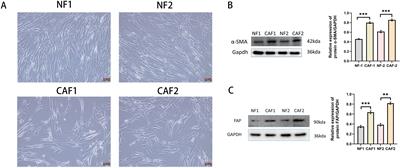 Anlotinib inhibits cervical cancer cell proliferation and invasion by suppressing cytokine secretion in activated cancer-associated fibroblasts